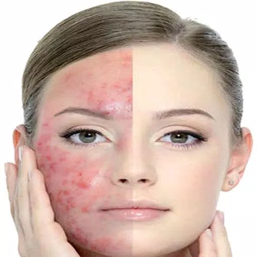 Get Rid of Acne  (Guide) स्क्रीनशॉट 1